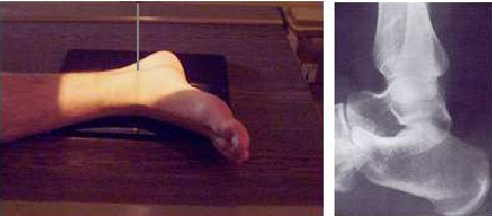 Proyección Lateral de Tobillo